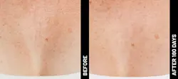Ultherapy: Non-Invasive Skin Tightening & Lifting Treatment