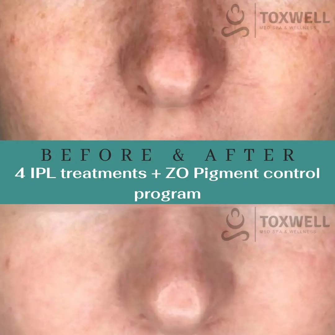 INTENSE PULSED LIGHT (IPL) THERAPY
