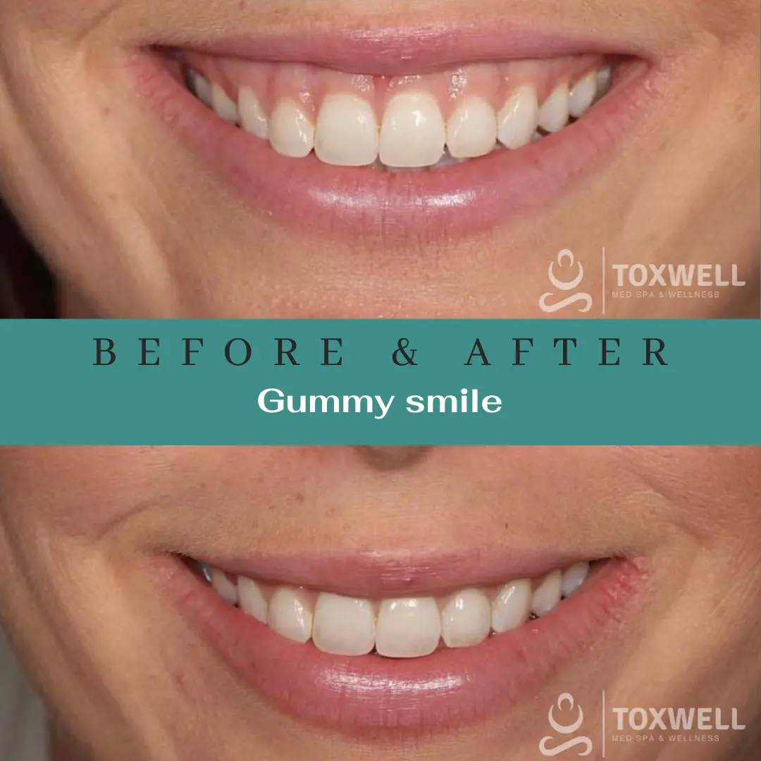 Dermal Filler