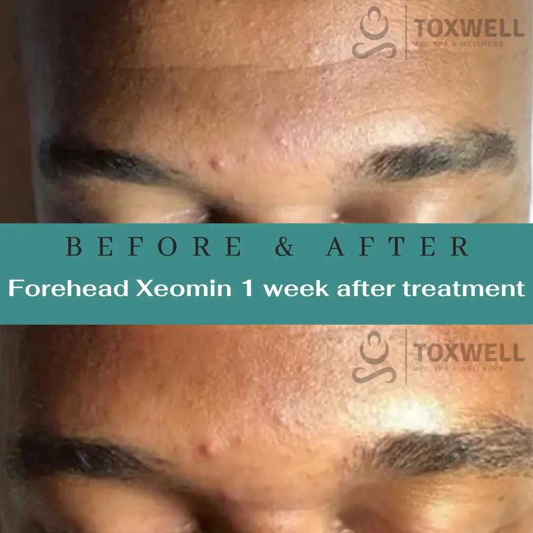 Botox injections