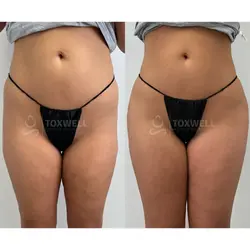 sculptra_liquid_bbl_non-surgical_brazilian_butt_lift