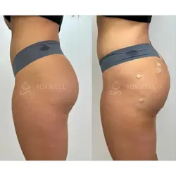 sculptra_liquid_bbl_non-surgical_brazilian_butt_lift