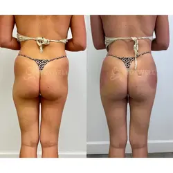 Side-by-side comparison of a woman's lower back and buttocks, possibly after a liquid BBL in Miami.