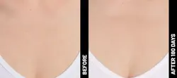 Ultherapy: Non-Invasive Skin Tightening & Lifting Treatment