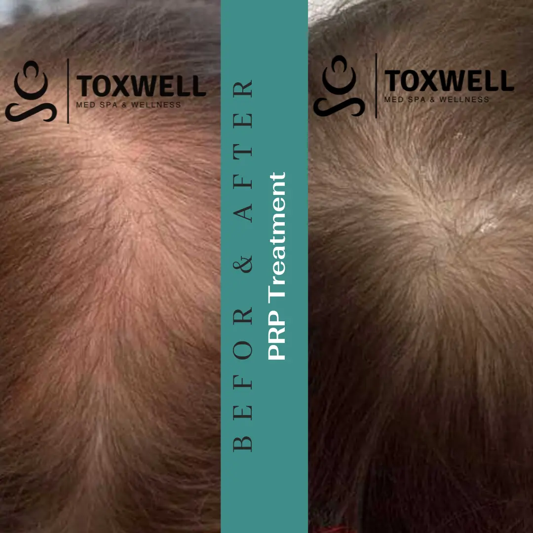 PRP Hair Loss Treatment