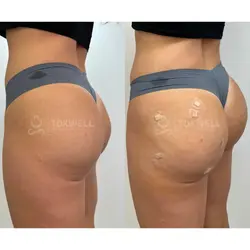 Side-by-side comparison of a woman's lower back and buttocks, possibly after a liquid BBL in Miami. 
