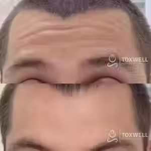 A before-and-after image of a forehead shows deep wrinkles erased after Botox injections in Hallandale and Aventura and Hollywood areas at Toxwell Med Spa. Both images display the "TOXWELL MED SPA + WELLNESS" logo in the lower right corner.