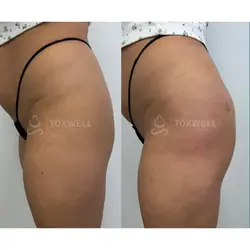 Side-by-side comparison of a woman's lower back and buttocks, possibly after a liquid BBL in Miami. 