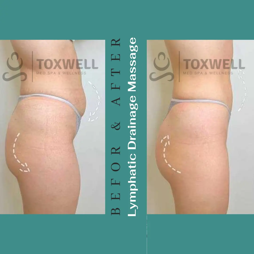 Body contouring