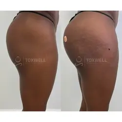 Side-by-side comparison of a woman's lower back and buttocks, possibly after a liquid BBL in Miami. 