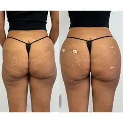 Side-by-side comparison of a woman's lower back and buttocks, possibly after a liquid BBL in Miami. 