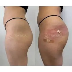 sculptra_liquid_bbl_non-surgical_brazilian_butt_lift