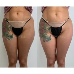 Side-by-side comparison of a woman's lower back and buttocks, possibly after a liquid BBL in Miami. 