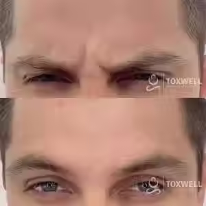 Two close-up photos of a person’s forehead highlight the effects of Glabella Botox injections in Hallandale and Hollywood areas at Toxwell Med Spa. The top shows deep lines; the bottom reveals a smoother, more relaxed look. The Toxwell Med Spa logo is present in both images.