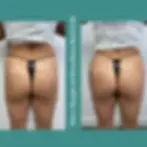 Two images of a person's back view showcasing the results of a liquid Sculptra Brazilian butt lift. On the left, they're in a dark thong and brown crop top, while the right image highlights noticeable enhancement. The teal background displays "Non-Surgical Brazilian Butt Lift.