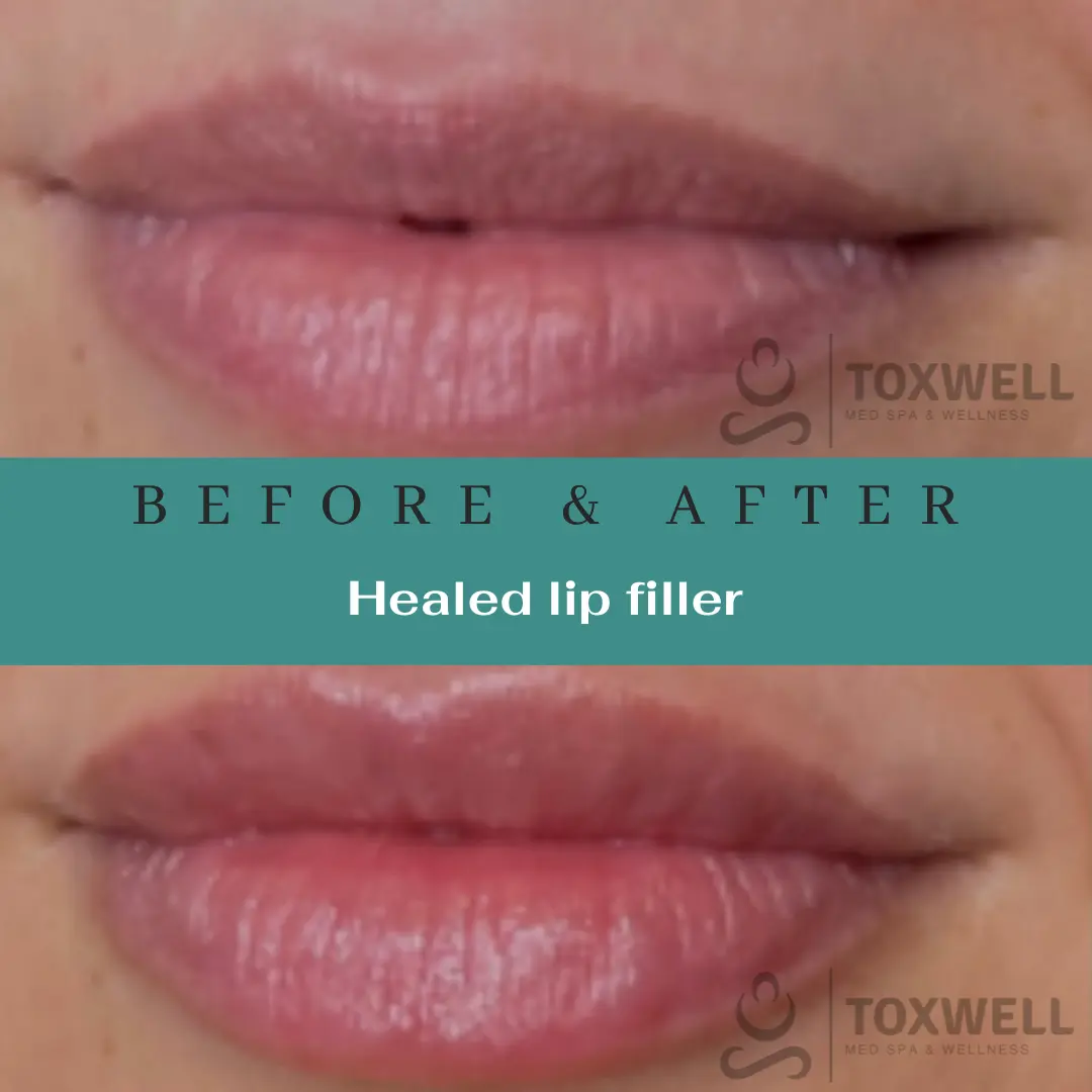 Dermal Filler