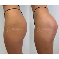 Side-by-side comparison of a woman's lower back and buttocks, possibly after a liquid BBL in Miami. 