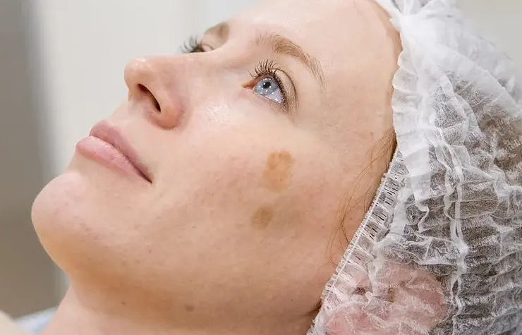 A person lying down with a hair cap, looking upward. Dark spots, indicative of hyperpigmentation, are visible on the cheek. IPL treatment might be a solution to consider.