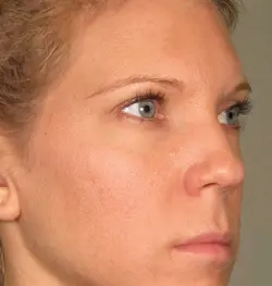 Ultherapy: Non-Invasive Skin Tightening & Lifting Treatment