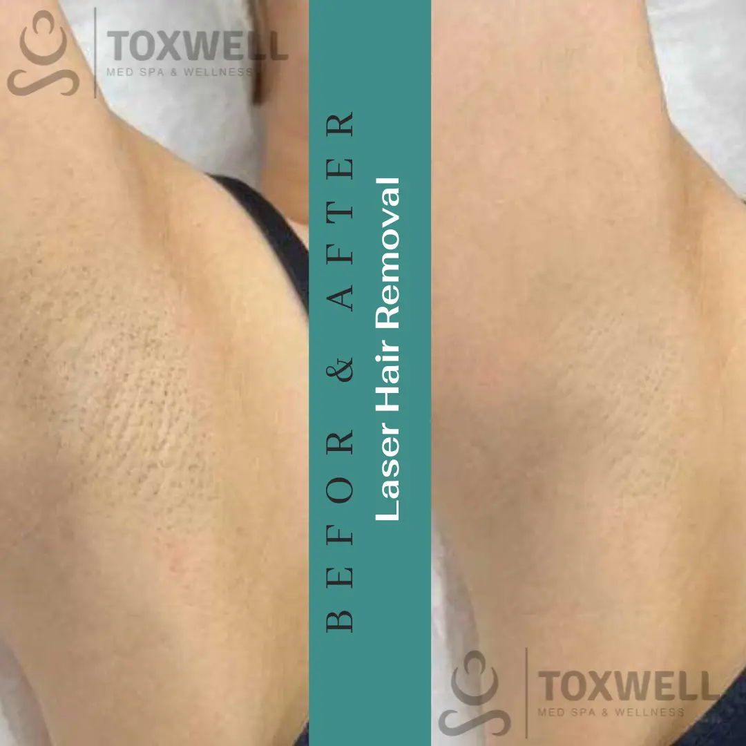 Laser Hair Removal