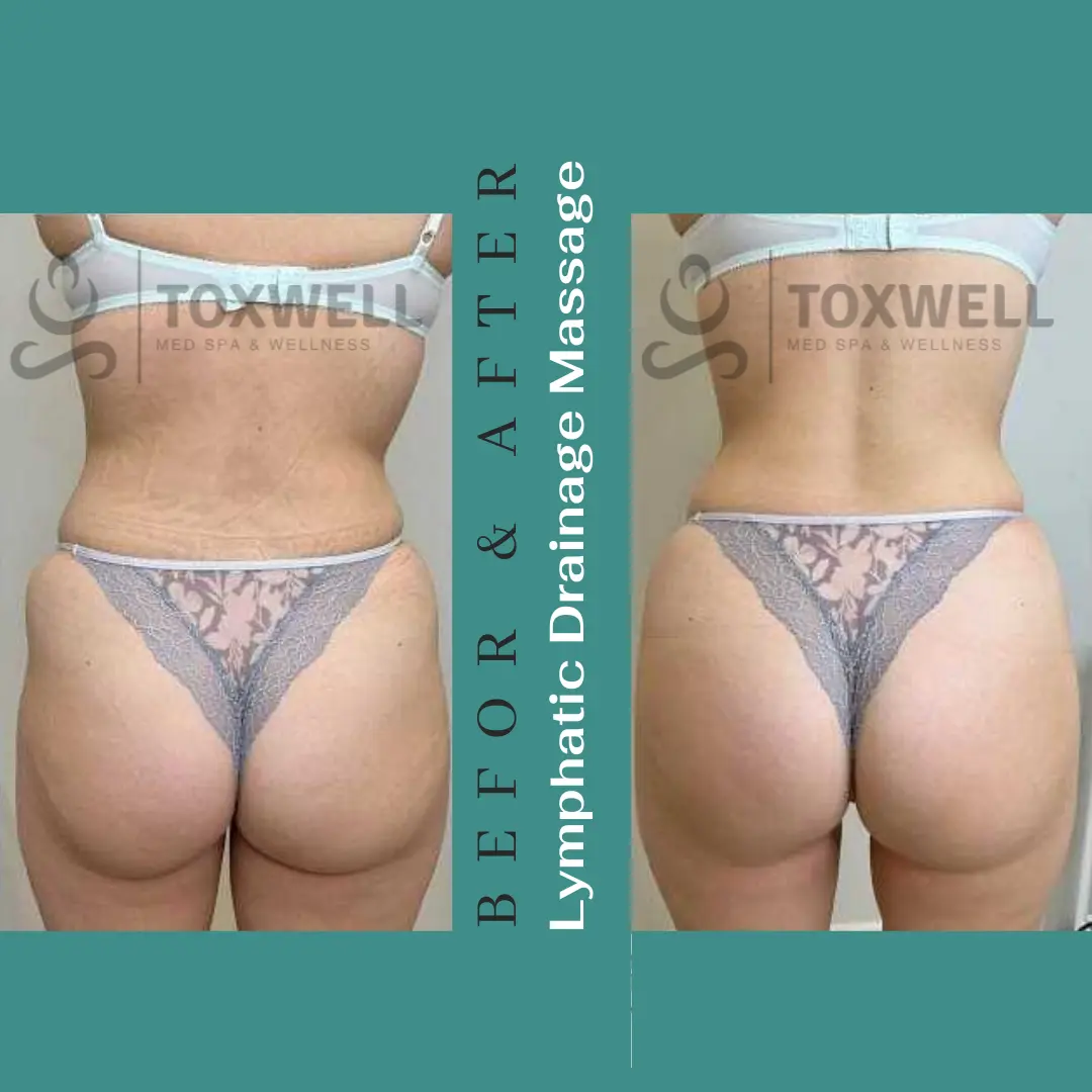 Body contouring