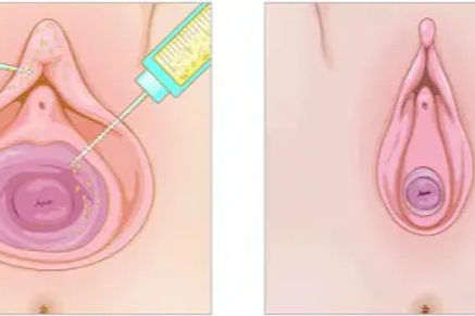 Illustration of two stages of a medical procedure for intimate rejuvenation involving the injection into a vaginal area. The left image shows a syringe above the clitoral hood with highlighted injection areas, while the right depicts a circular area showing the intended treatment effect.