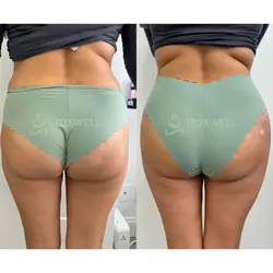 sculptra_liquid_bbl_non-surgical_brazilian_butt_lift