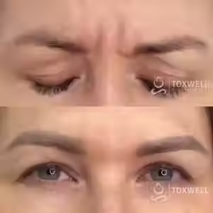 Two close-up photos of a person’s forehead highlight the effects of Glabella Botox injections in Hallandale and Hollywood areas at Toxwell Med Spa. The top shows deep lines; the bottom reveals a smoother, more relaxed look. The Toxwell Med Spa logo is present in both images.