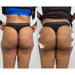 Side-by-side comparison of a woman's lower back and buttocks, possibly after a liquid BBL in Miami. 
