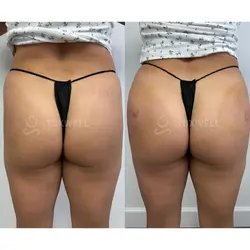 Side-by-side comparison of a woman's lower back and buttocks, possibly after a liquid BBL in Miami. 