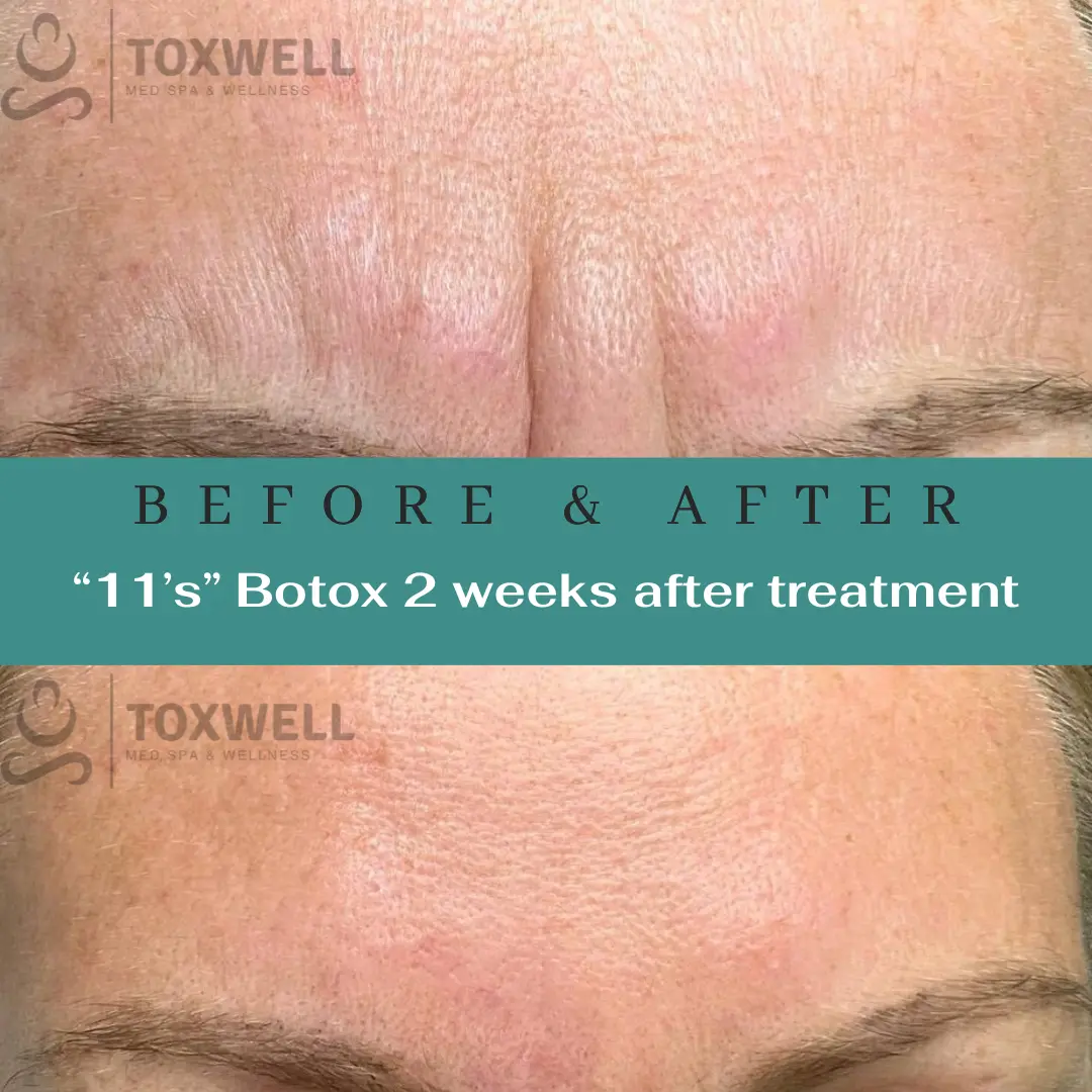 Botox injections