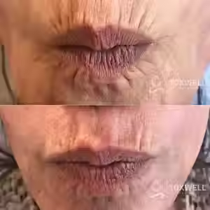 Close-up of an older person's pursed lips and surrounding wrinkled skin, shown in two side-by-side images. The smoother, refreshed appearance in the bottom image highlights results from Lip Flip Botox Injections in Hallandale and Hollywood at Toxwell Med Spa.