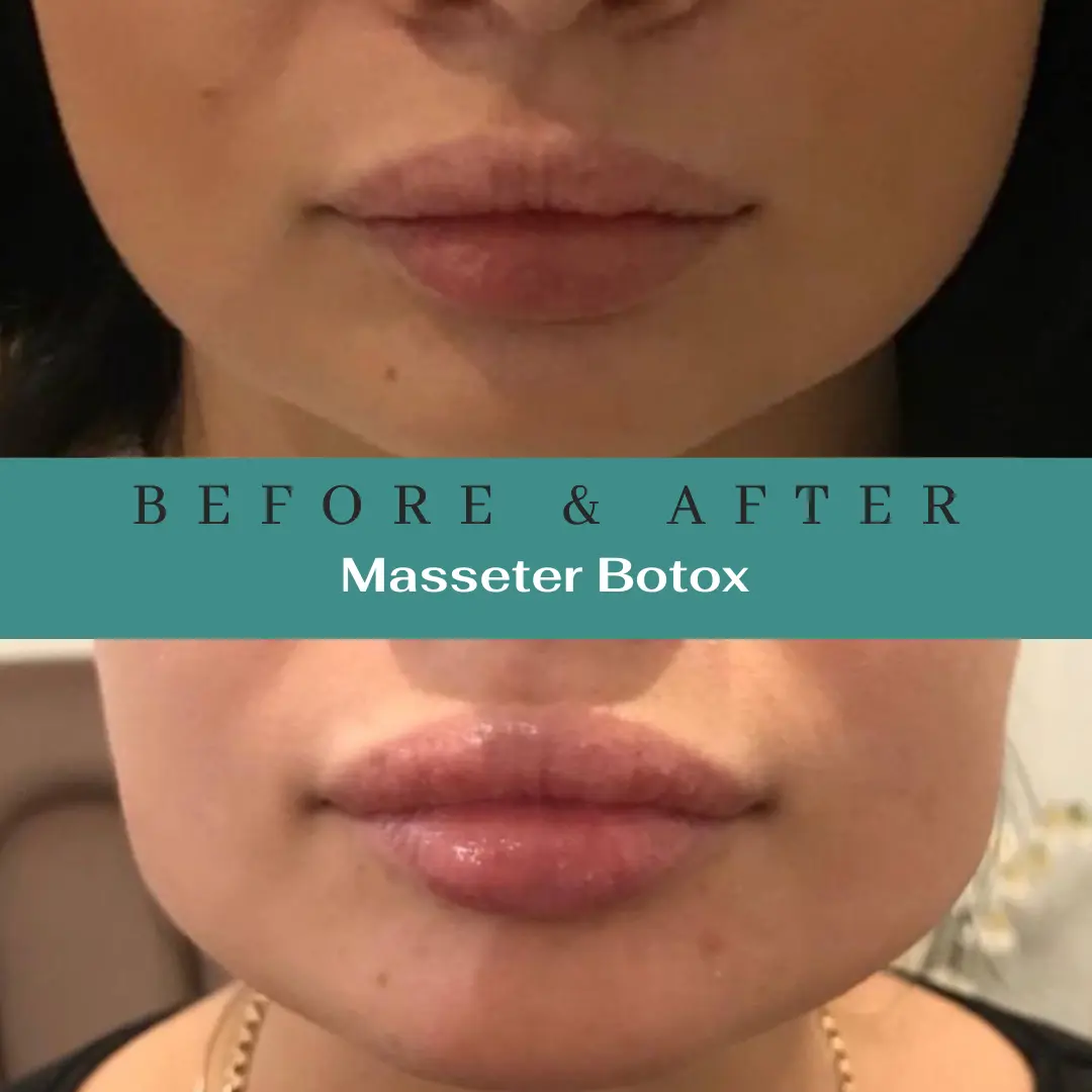 Botox injections