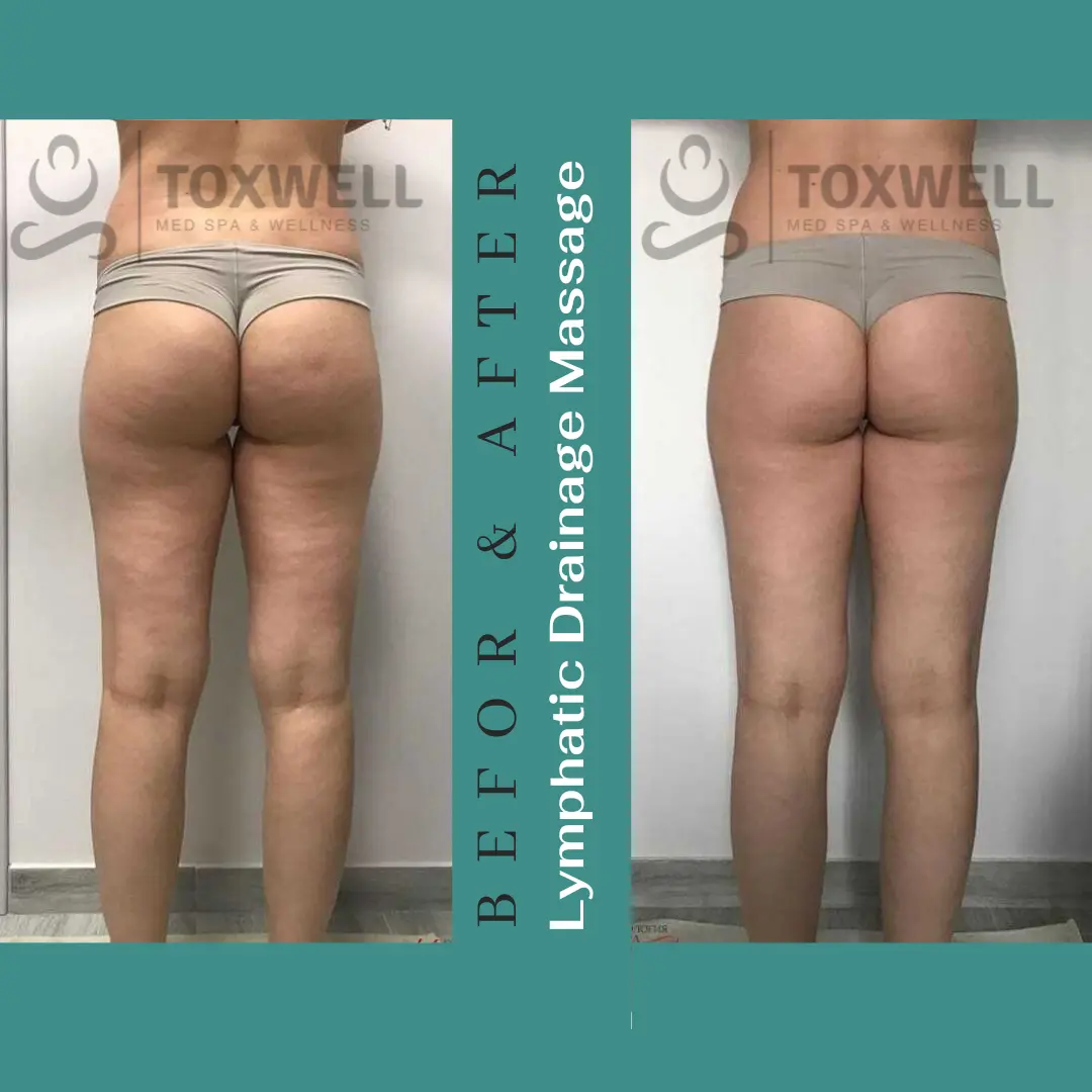 Body contouring