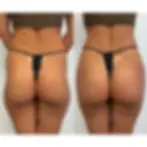Two side-by-side comparison photos showing a person's lower back and buttocks in a black bikini. Background is plain white. Text: "Toxwell".