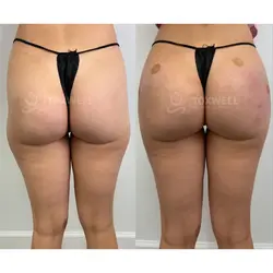 Side-by-side comparison of a woman's lower back and buttocks, possibly after a liquid BBL in Miami. 