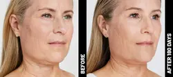 Ultherapy: Non-Invasive Skin Tightening & Lifting Treatment