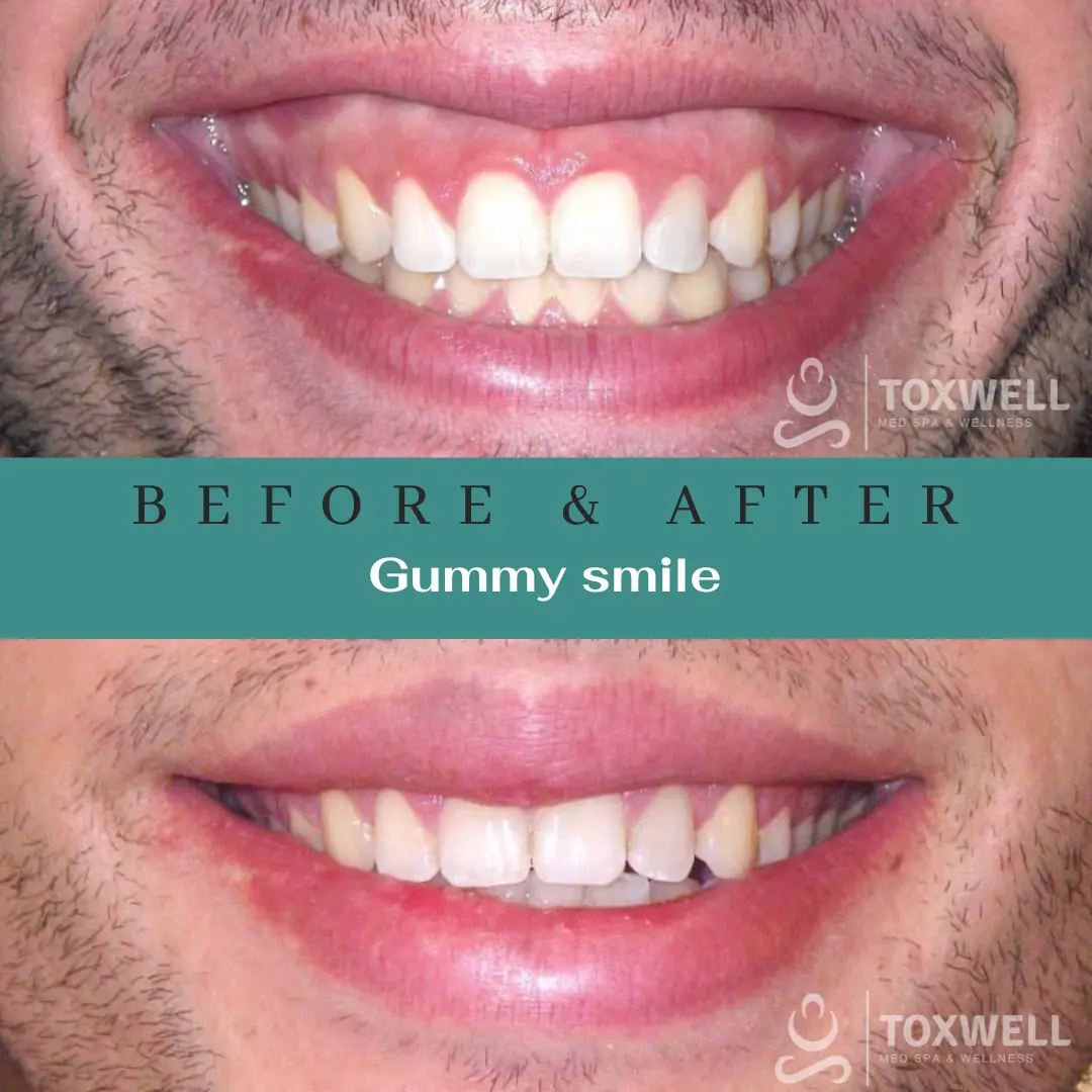 Dermal Filler