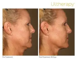 Ultherapy: Non-Invasive Skin Tightening & Lifting Treatment