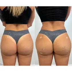 sculptra_liquid_bbl_non-surgical_brazilian_butt_lift