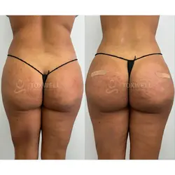 Side-by-side comparison of a woman's lower back and buttocks, possibly after a liquid BBL in Miami. 