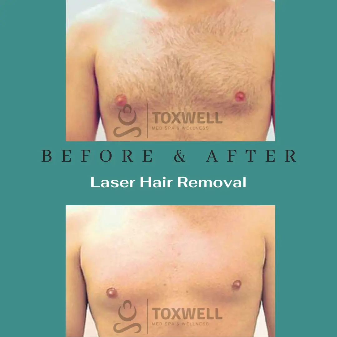 Laser Hair Removal