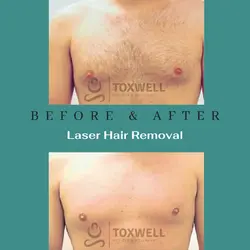 Laser Hair Removal
