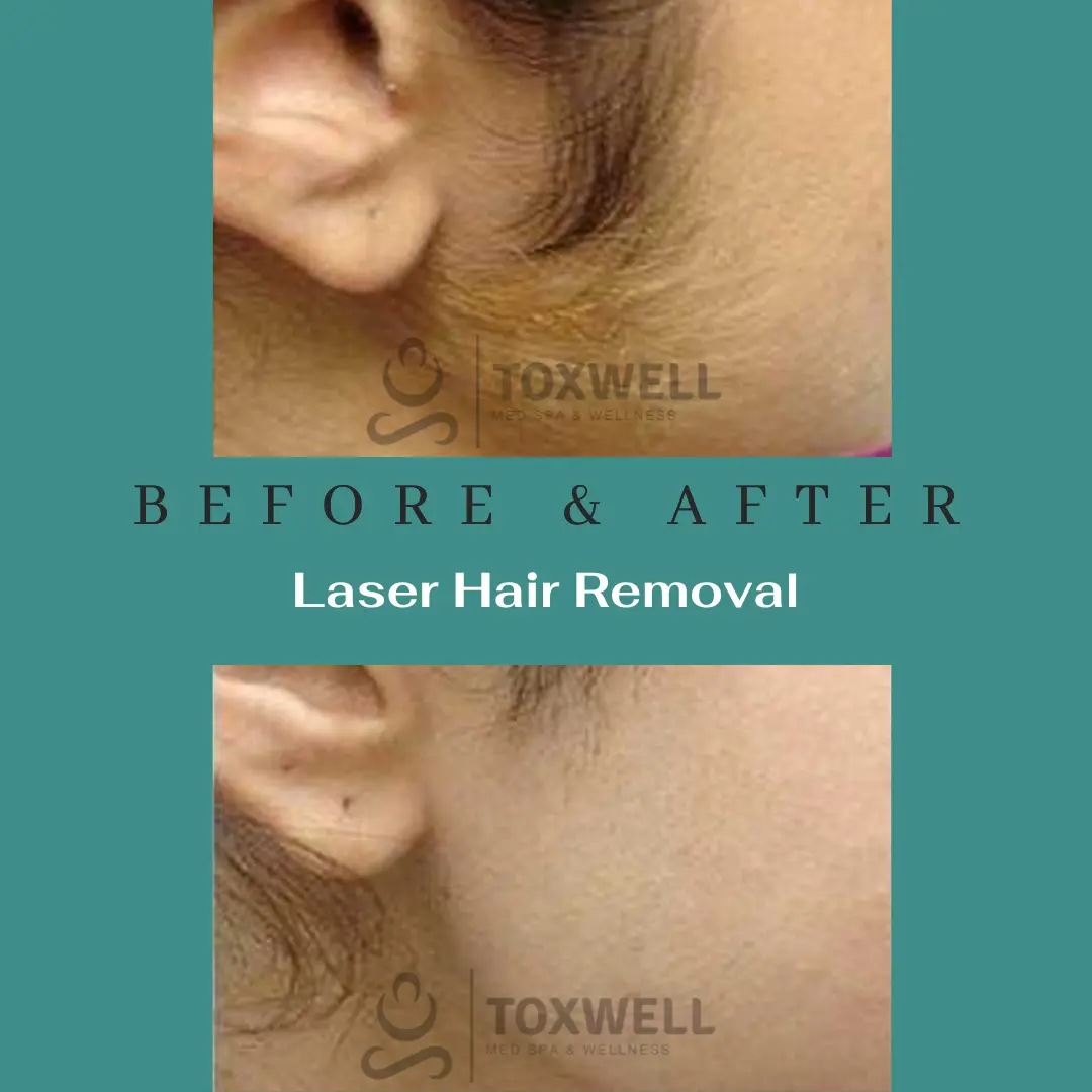 Laser Hair Removal