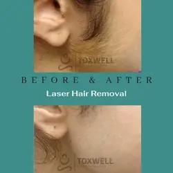 Laser Hair Removal