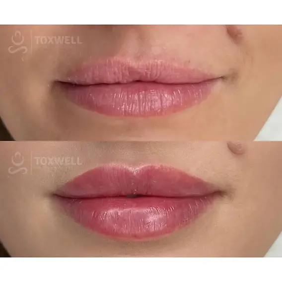 LOOKING FOR THE BEST MED SPA FOR LIP FILLER IN HALLANDALE?