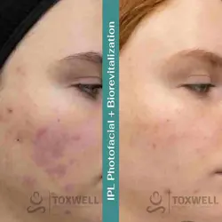 IPL Photofacial Therapy