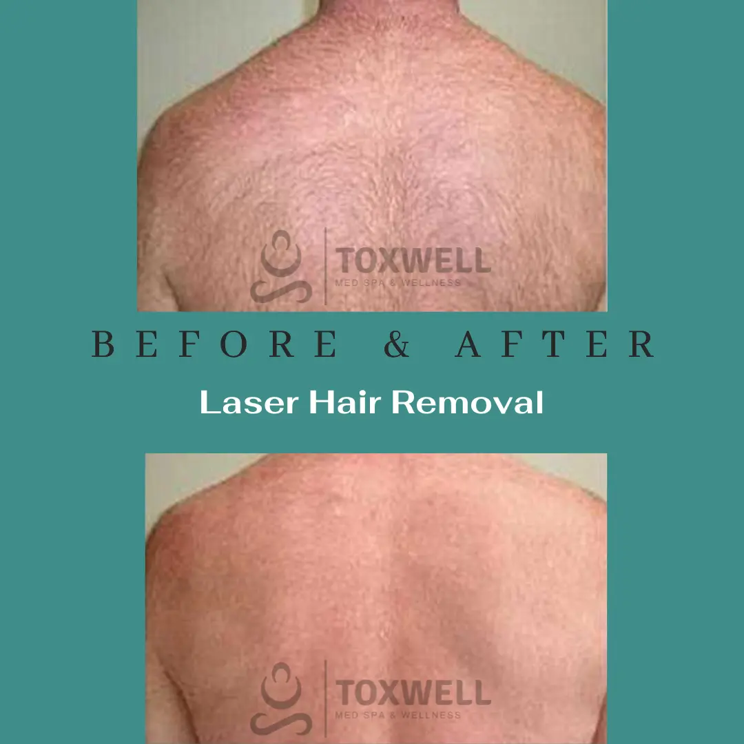 Laser Hair Removal