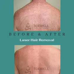 Laser Hair Removal
