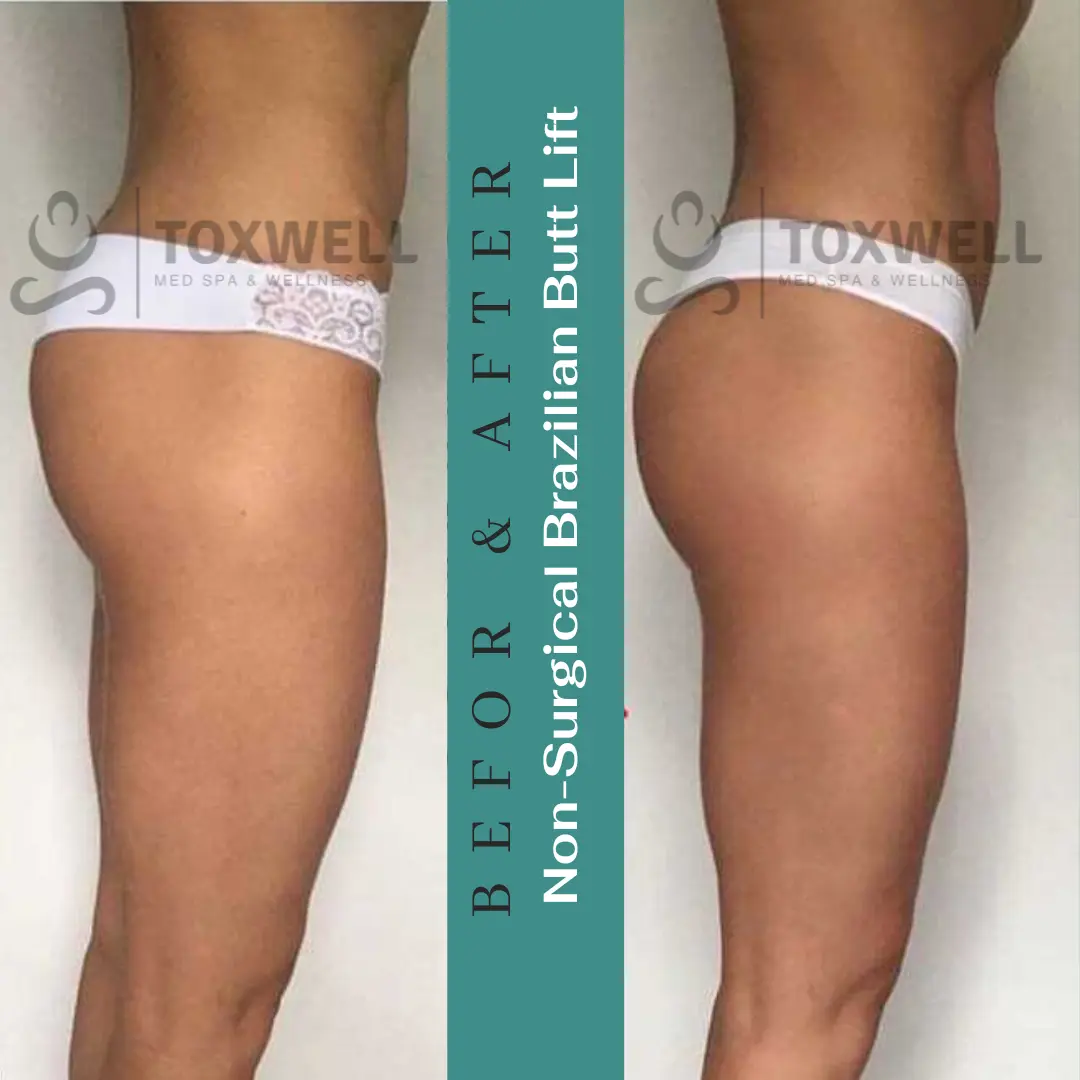 The image features a side-by-side comparison of a woman's lower body in a "before and after" format for a LIQUID NON-SURGICAL BRAZILIAN BUTT LIFT (BBL). She is wearing pink underwear, and the noticeable change is the lift and enhanced shape of her buttocks. The "after" side shows a more contoured and lifted appearance.